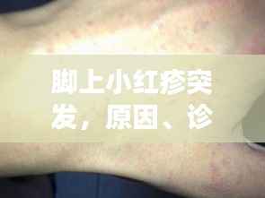 脚上小红疹突发，原因、诊断及有效治疗方法全解析
